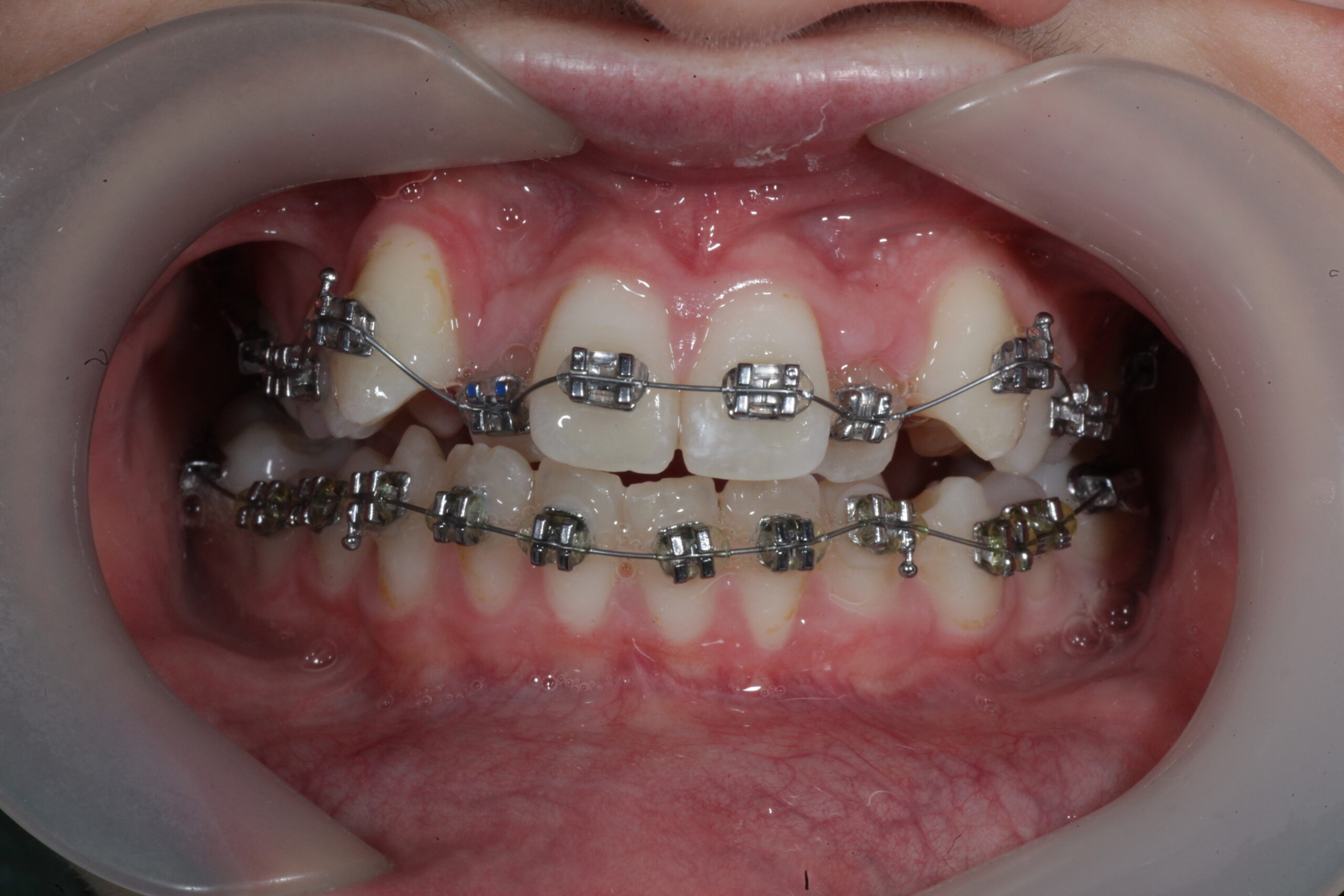 Before